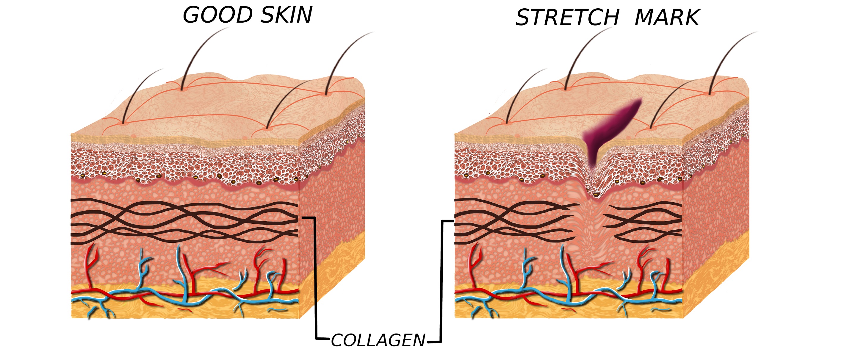 Трещина после родов. Строение кожи коллаген эластин. Коллаген эластин фибробласты. Кожа в разрезе. Коллаген для кожи.